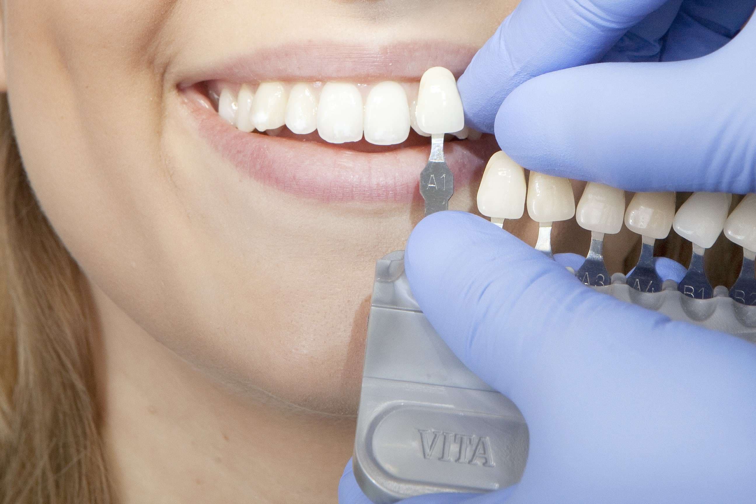 Esthetic dentistry case